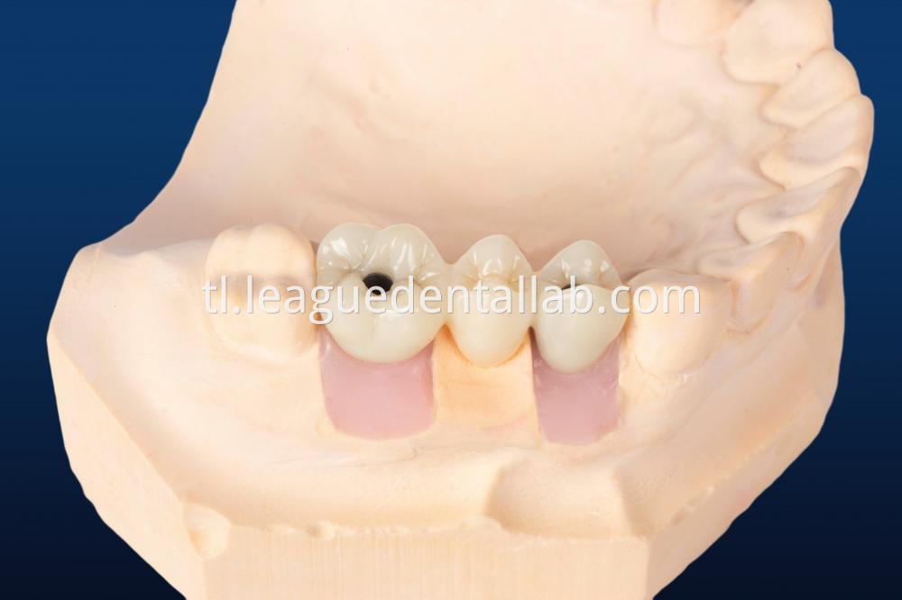 Dental Implant Crown, Dental Implant Zirconia crown,Dental Implant Emax crown,Dental Implant Bridge
